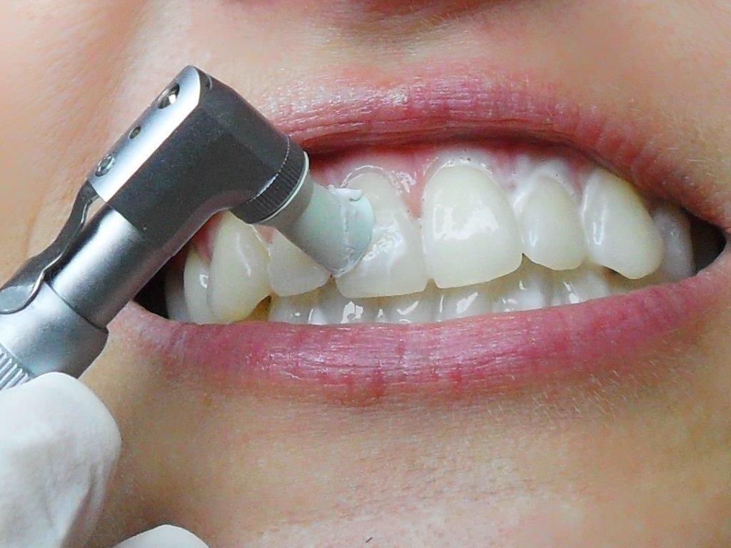 Professionelle kosmetische Zahnreinigung